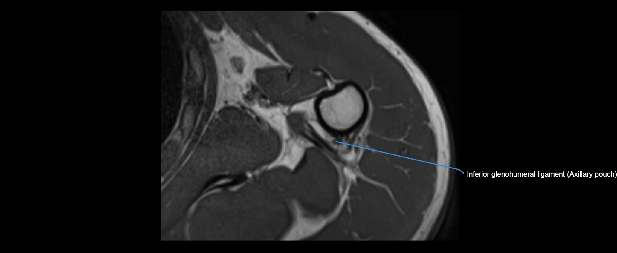 shoulder ligaments axial 3d 3t mri image-img-00005-00102.webp
